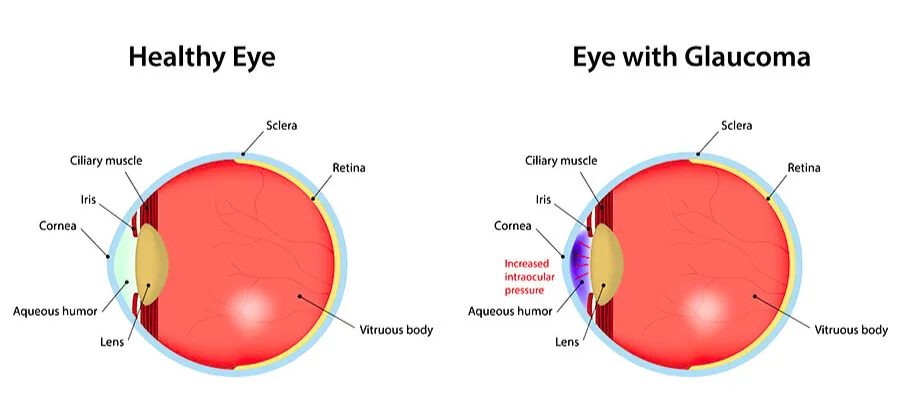 Illustration showing the gap between eye pressure control and ongoing vision decline